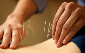 Acupunctura